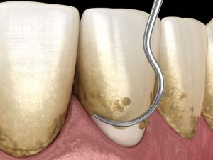 Plastyka dziąseł dentysta stomatologia estetyczna