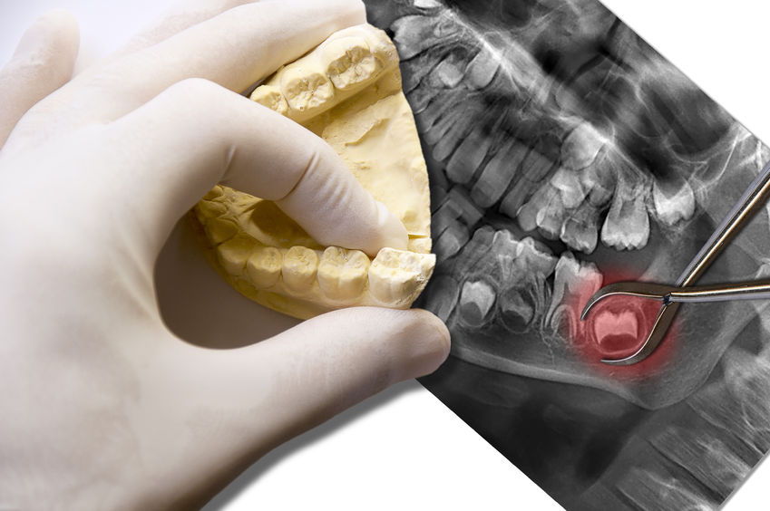 Usunięcie korzenia zęba -chirurgia stomatologiczna