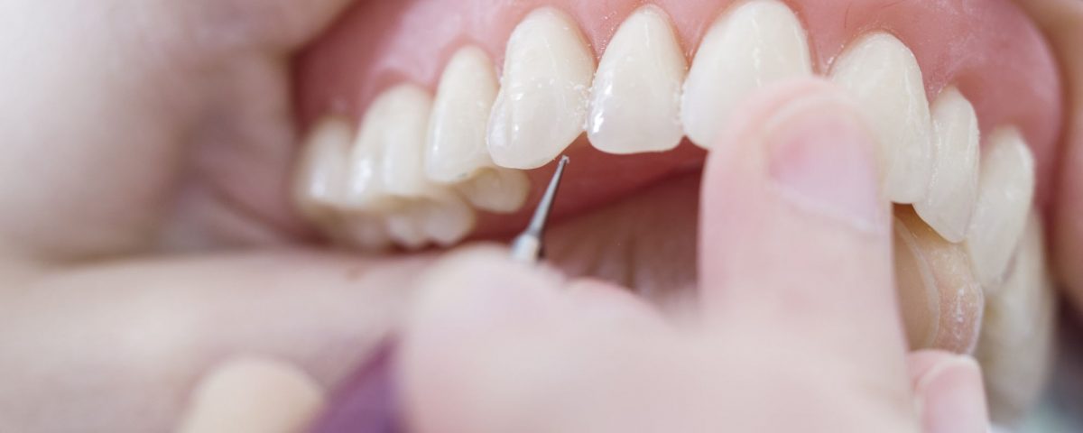 jak dbać o protezę zębów? dlaczego należy zdjąć protezę przed snem?
